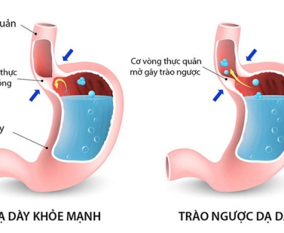 Bệnh trào ngược dạ dày thực quản: những vấn đề chung